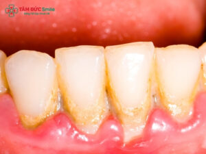 Cao răng là gì? Quy trình lấy cao răng tại nha khoa diễn ra như thế nào? 