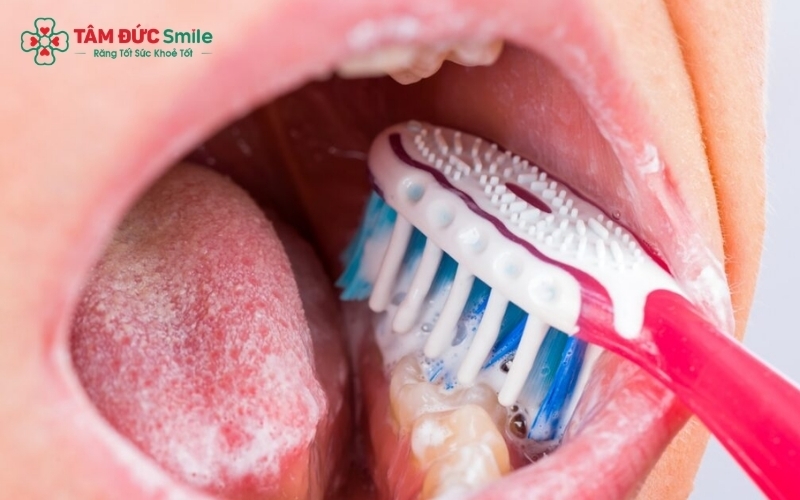 Kết hợp vệ sinh răng miệng đúng cách với chỉ nha khoa, máy tăm nước giúp ngăn ngừa cao răng quay trở lại.