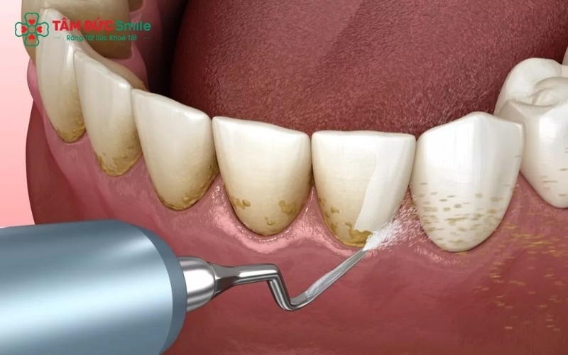 Công nghệ cạo vôi siêu âm hiện đại chỉ tác động vào mảng bám, đảm bảo an toàn tuyệt đối cho men răng khỏe mạnh.