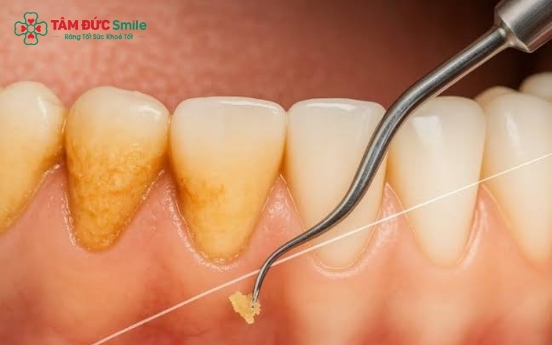 Răng lung lay do viêm nha chu, không phải do cạo vôi răng