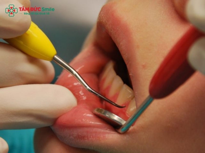 Cạo vôi răng có hại không?