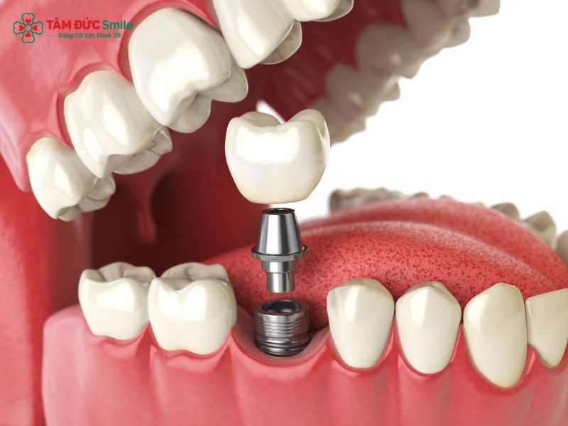 cay-ghep-implant-1