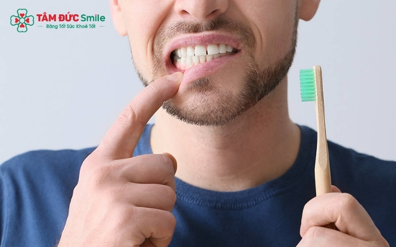 Hậu quả của việc đánh răng quá mạnh bằng bàn chải cứng gây mòn cổ răng và ê buốt.
