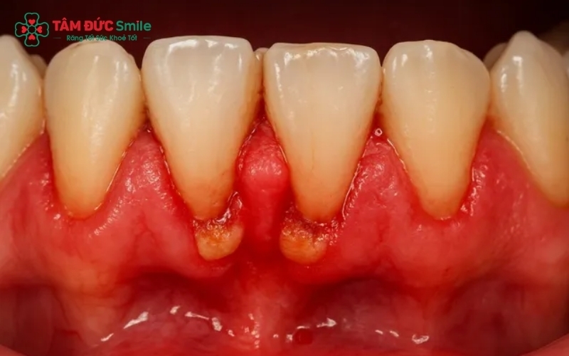 Chảy máu chân răng thường xuyên là dấu hiệu cảnh báo nướu đang bị viêm và cần được kiểm tra sớm.