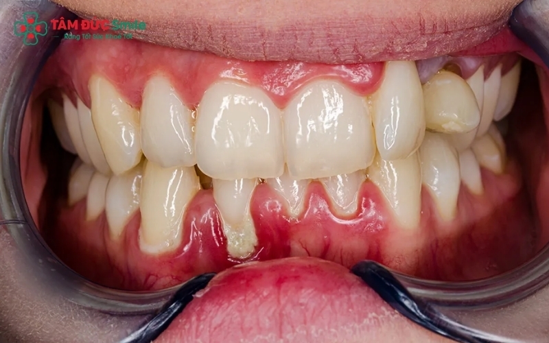 Mảng bám và cao răng tích tụ là nguyên nhân hàng đầu khiến nướu bị sưng viêm, dễ chảy máu khi tác động nhẹ.