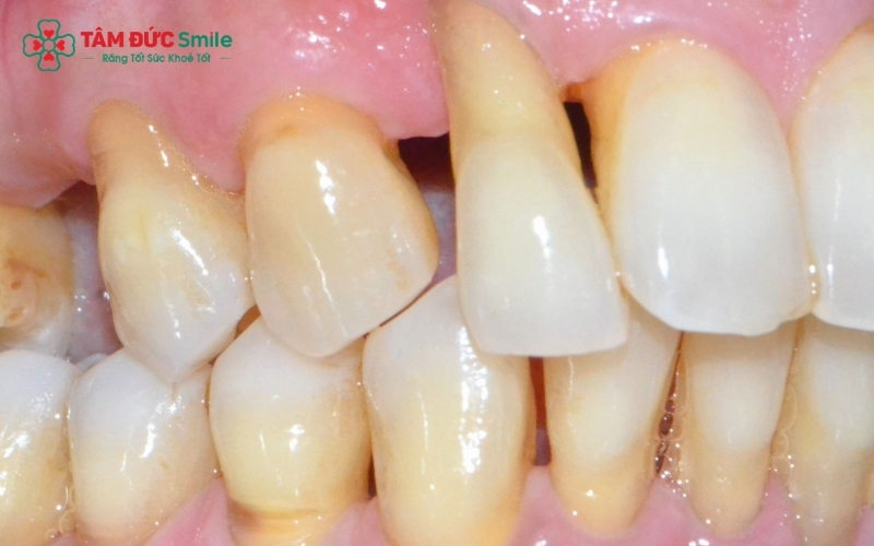 Chảy máu chân răng không được điều trị có thể dẫn đến viêm nha chu, gây tiêu xương và nguy cơ mất răng vĩnh viễn.