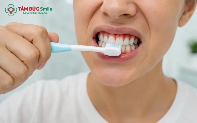 Vệ sinh răng miệng đúng cách với bàn chải lông mềm và chỉ nha khoa giúp làm sạch mảng bám mà không gây tổn thương nướu.