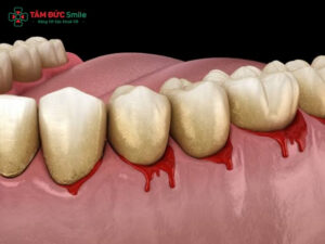 Chảy máu chân răng: Nguyên nhân, cách điều trị, phòng ngừa