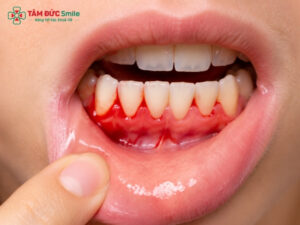 Chảy máu chân răng phải làm sao?