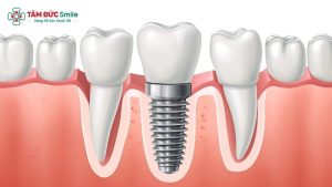 Trồng răng Implant là phương pháp phục hình răng hiện đại