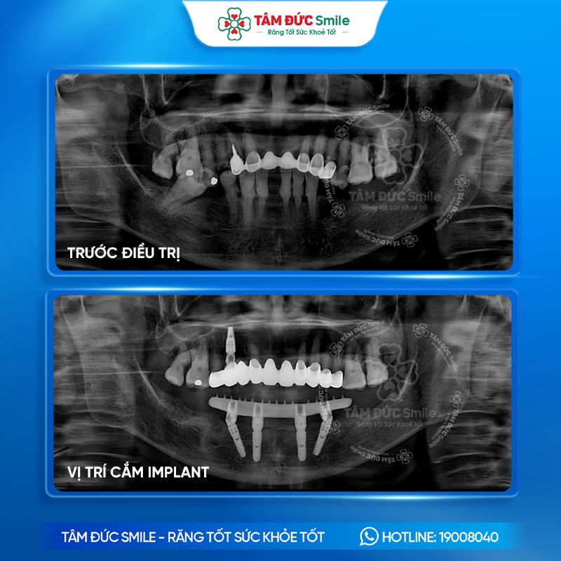 chi-phi-trong-rang-implant-all-on-4-1159-1