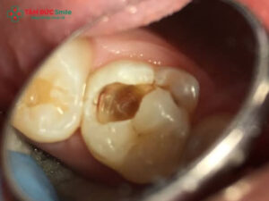 Cách chữa đau răng sâu an toàn, hiệu quả