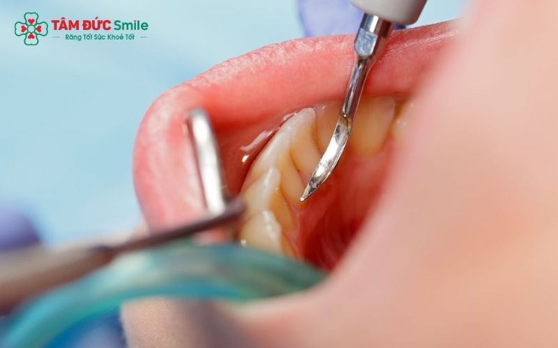 Không dựa vào độ tuổi, bác sĩ sẽ thăm khám trực tiếp để xác định thời điểm cần làm sạch cao răng cho bé.