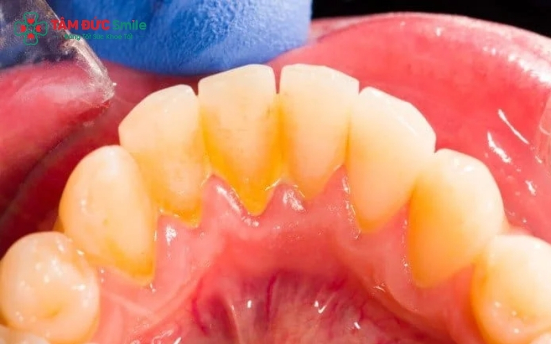 Cao răng lâu ngày không được xử lý là nguyên nhân chính dẫn đến viêm nướu, chảy máu chân răng và hôi miệng ở trẻ.