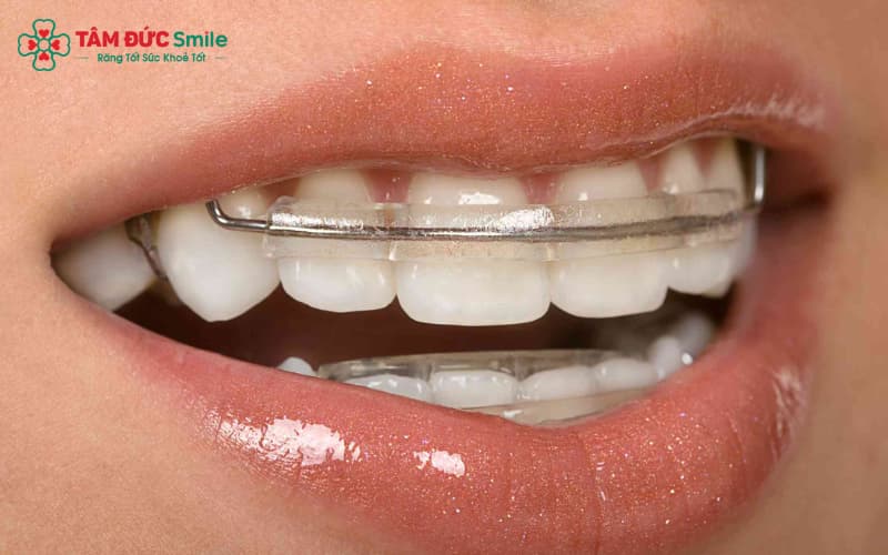 Hàm duy trì giữ ổn định kết quả sau niềng răng