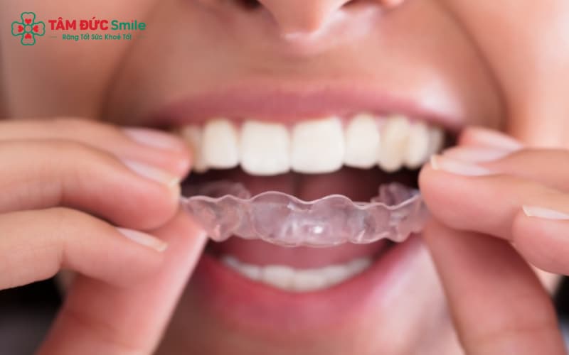 Hàm duy trì tháo lắp có thẩm mỹ cao, dễ dàng sử dụng.