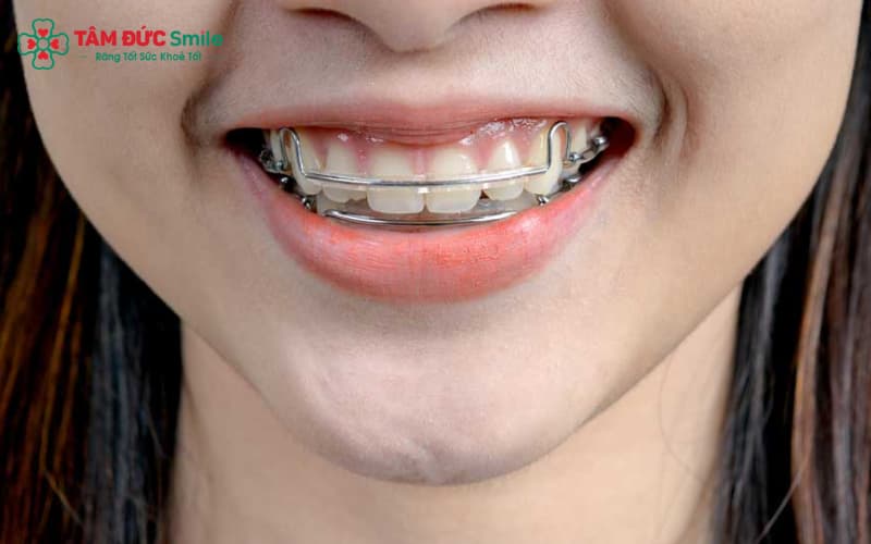 Vệ sinh hàm cố định thường xuyên bằng dụng cụ chuyên dụng