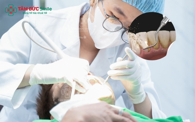 Lấy cao răng định kỳ tại Nha khoa Tâm Đức Smile giúp loại bỏ triệt để nguồn gây mùi, mang lại hơi thở thơm mát và nướu khỏe mạnh.