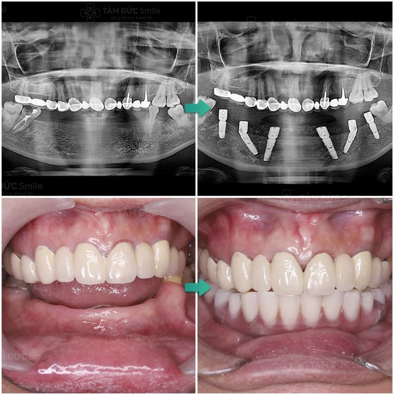 implant-all-on-6-la-gi-khi-nao-nen-trong-implant-all-on-6-4
