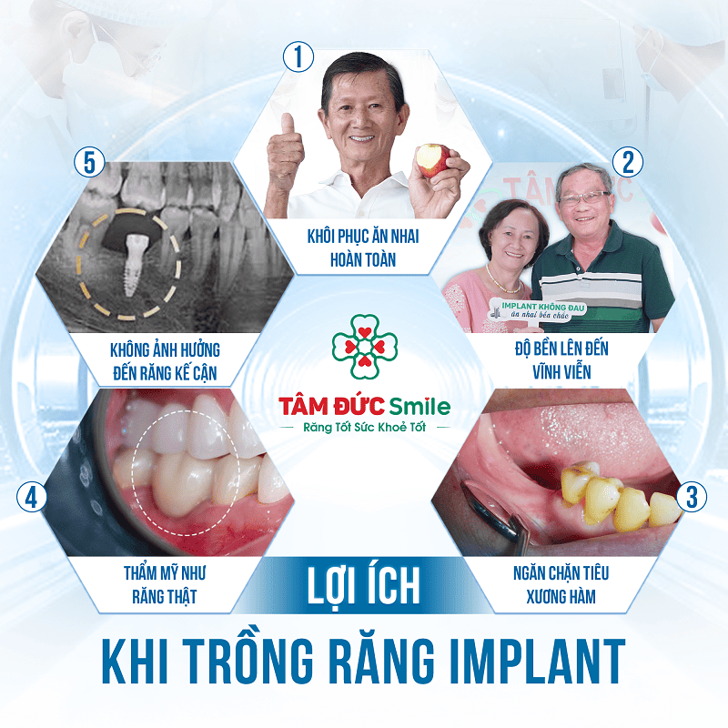 cay-ghep-implant-da-bao-gom-abutment-11-11