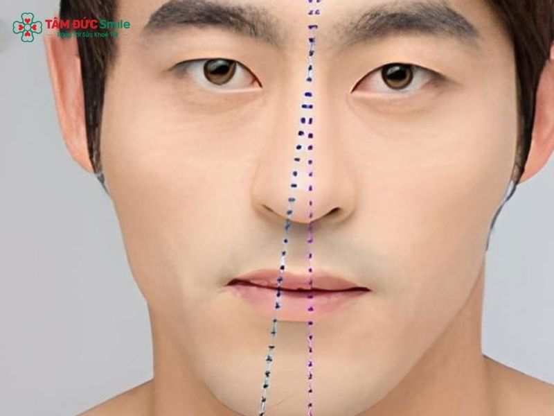 Lệch khớp cắn có thể ảnh hưởng đến trục gương mặt