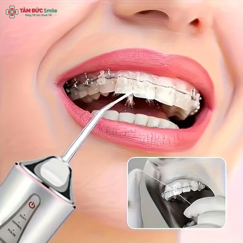 Sử dụng máy tăm nước khi niềng răng giúp làm sạch răng miệng hiệu quả hơn
