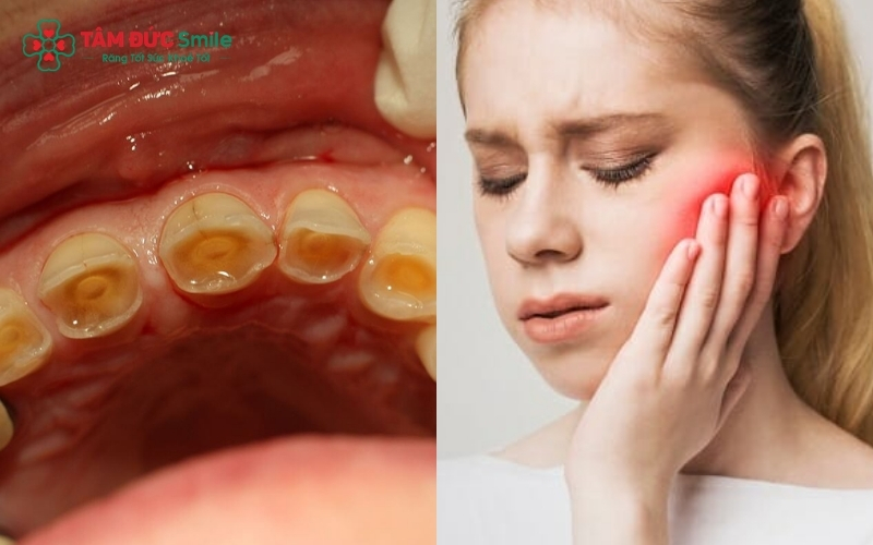 Răng bị mài mòn phẳng lì và đau khớp thái dương hàm vào buổi sáng thường do các cơ nhai phải hoạt động quá mức trong đêm