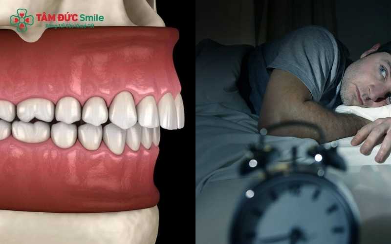 Sai lệch khớp cắn khiến các răng không tìm được điểm nghỉ tối ưu, dễ gây ra tình trạng siết chặt hàm.