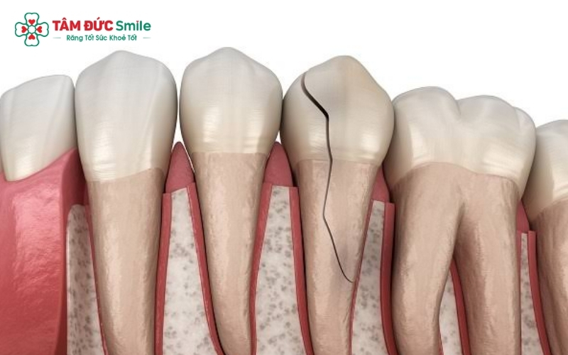 Nghiến răng tạo áp lực cực lớn có thể làm vỡ cả răng thật lẫn răng sứ, gây tốn kém chi phí sửa chữa