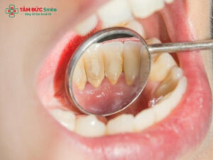 Nguyên nhân gây hôi miệng thường gặp nhất