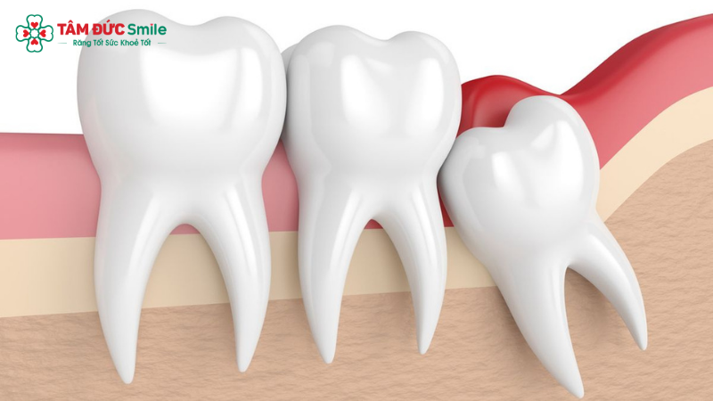Răng khôn là răng số 8 nằm trong cùng cung hàm, có thể mọc thẳng, mọc lệch hoặc mọc ngầm