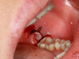 Thẻ bảo hành răng sứ Zirconia: Thời hạn, cách kiểm tra và điều kiện áp dụng
