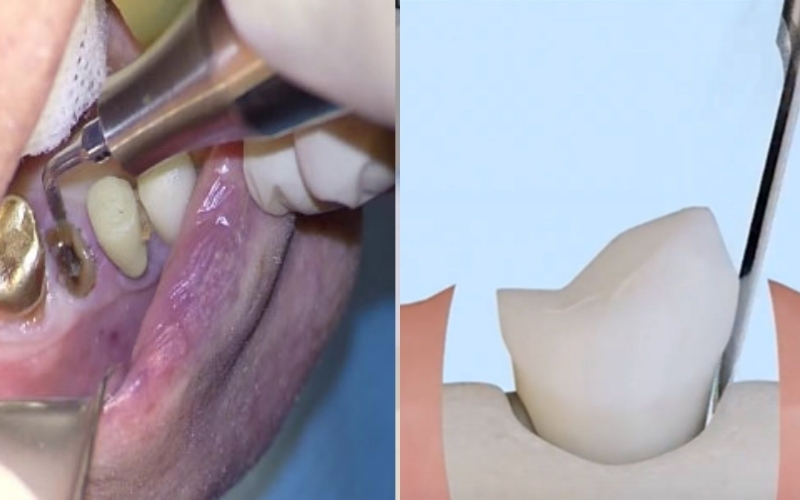 Lựa chọn công nghệ nhổ răng hiện đại giúp giảm thiểu chấn thương mô, ngăn ngừa đau đầu hiệu quả.
