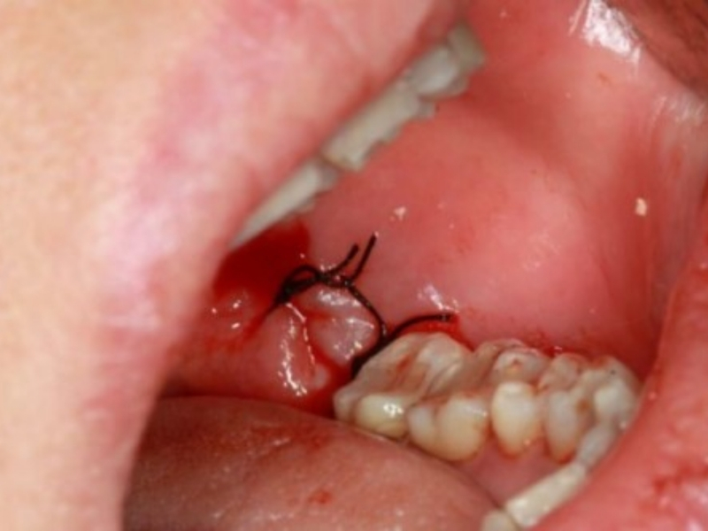 Thẻ bảo hành răng sứ Zirconia: Thời hạn, cách kiểm tra và điều kiện áp dụng