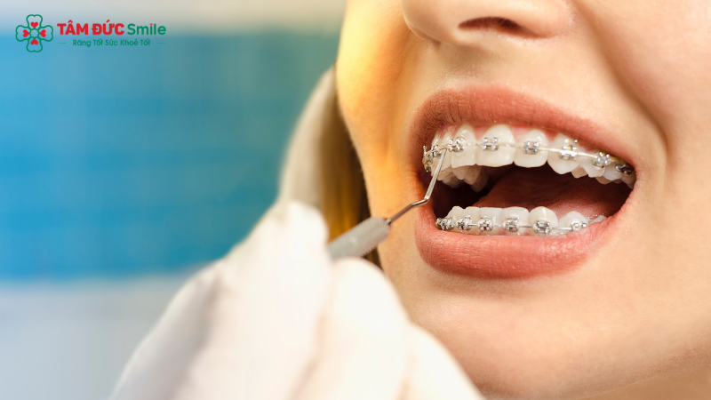Niềng răng giai đoạn đầu có thể gây khó chịu, trầy xước trong miệng