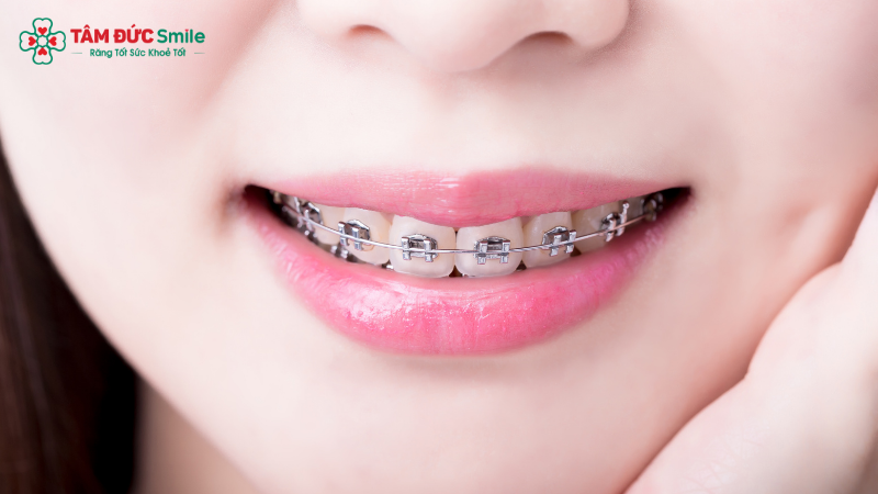Niềng răng không chỉ giúp răng đều đẹp mà còn cải thiện tỷ lệ khuôn mặt hài hòa hơn