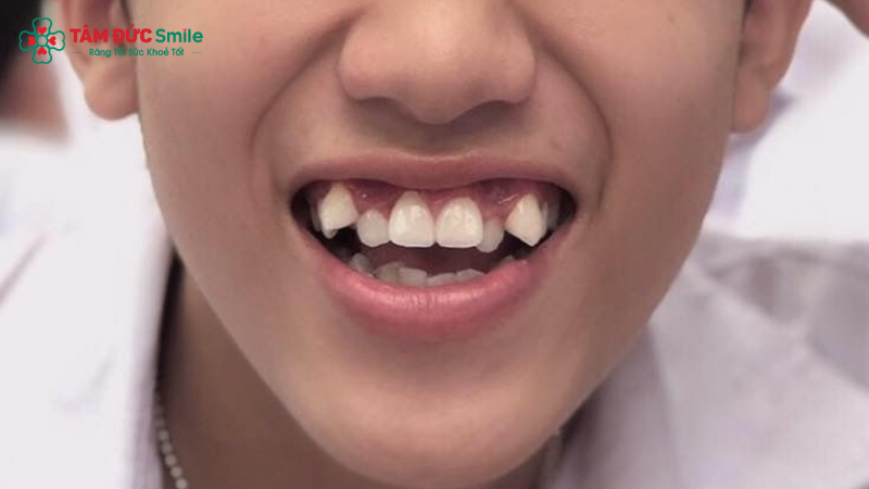 Răng khểnh là răng nanh mọc lệch ra ngoài cung hàm