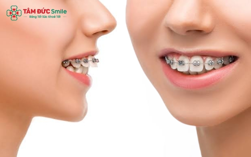 Niềng răng hô không chỉ giúp răng đều đẹp mà còn cải thiện góc nghiêng, giúp nụ cười tự tin và khuôn mặt cân đối hơn.