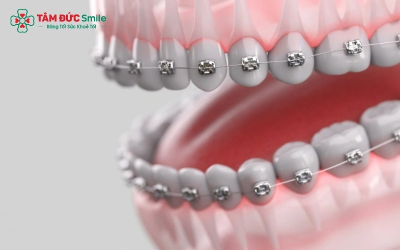 Niềng răng hô giúp đưa nhóm răng cửa nhô ra trước về đúng vị trí, điều chỉnh khớp cắn và cấu trúc cung hàm.