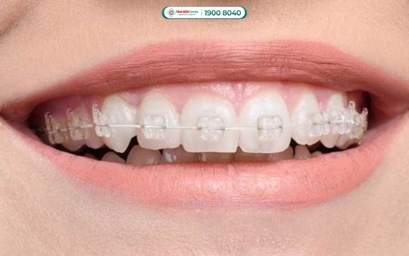Niềng răng mắc cài pha lê sử dụng hệ thống mắc cài pha lê nguyên khối trong suốt