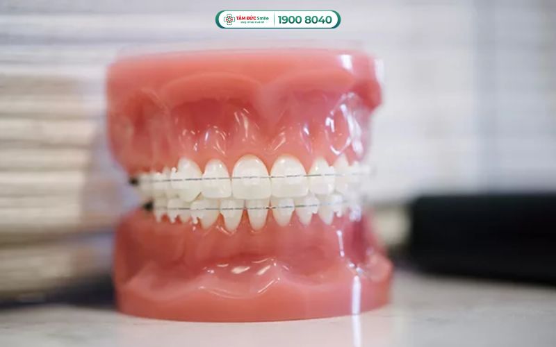 Niềng răng mắc cài pha lê dao động từ 30.000.000 – 45.000.000 VNĐ/2 hàm