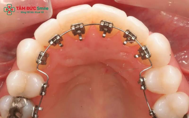 Chỉnh nha mặt trong giúp ẩn hoàn toàn khí cụ, duy trì vẻ ngoài tự nhiên
