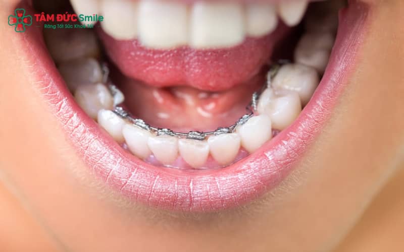 Niềng răng mặt trong đảm bảo tính thẩm mỹ cao suốt quá trình chỉnh nha