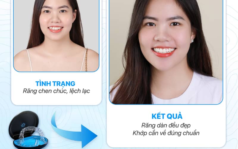 Niềng răng mặt lưỡi là giải pháp cho nụ cười hoàn hảo, giữ trọn tính thẩm mỹ
