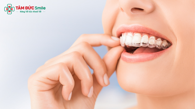 nieng-rang-invisalign-1