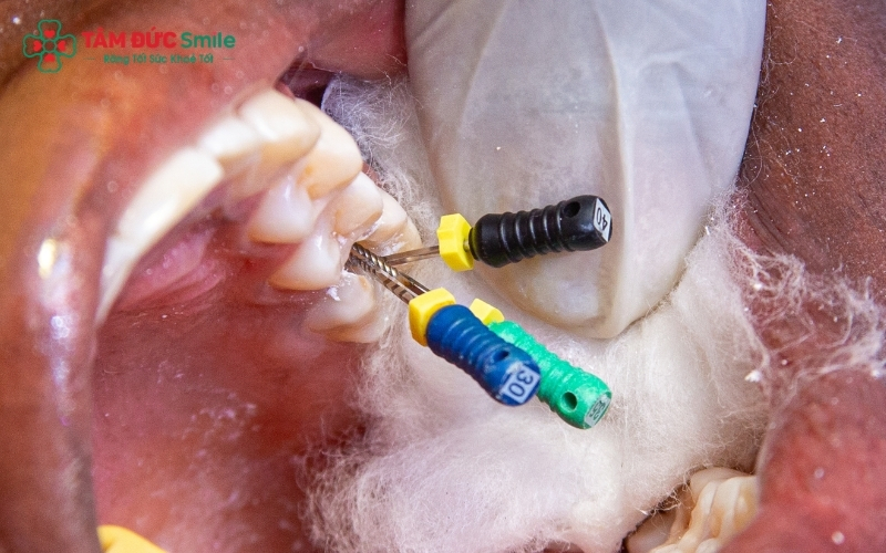 Khách hàng có thể hoàn toàn an tâm về một trải nghiệm điều trị tủy nhẹ nhàng, không đau đớn.
