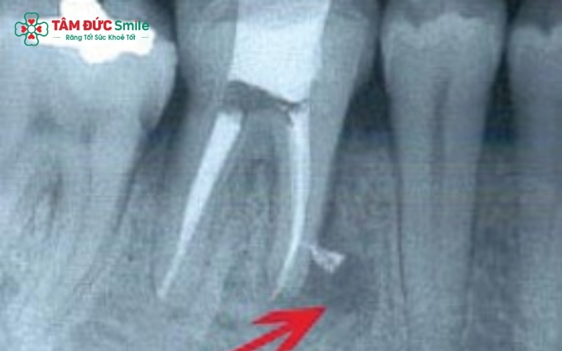Phim X-quang giúp bác sĩ kiểm tra mức độ nhiễm trùng và đảm bảo ống tủy được trám bít kín khít, ngăn ngừa biến chứng áp xe chân răng.