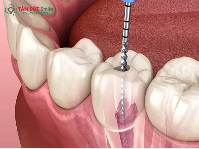 Quy trình điều trị tủy răng tại nha khoa