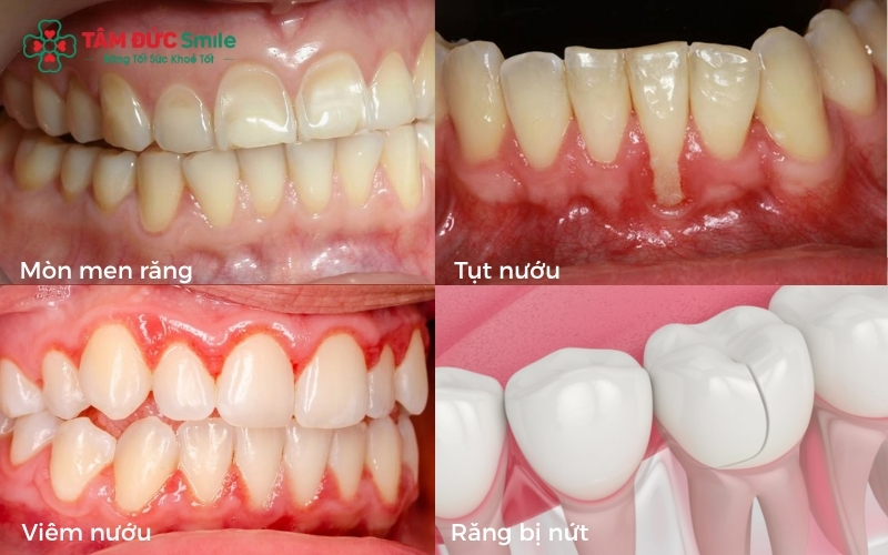 Nguyên nhân gây ê buốt răng thường gặp ạo điều kiện cho vi khuẩn và nhiệt độ tác động trực tiếp lên tủy răng