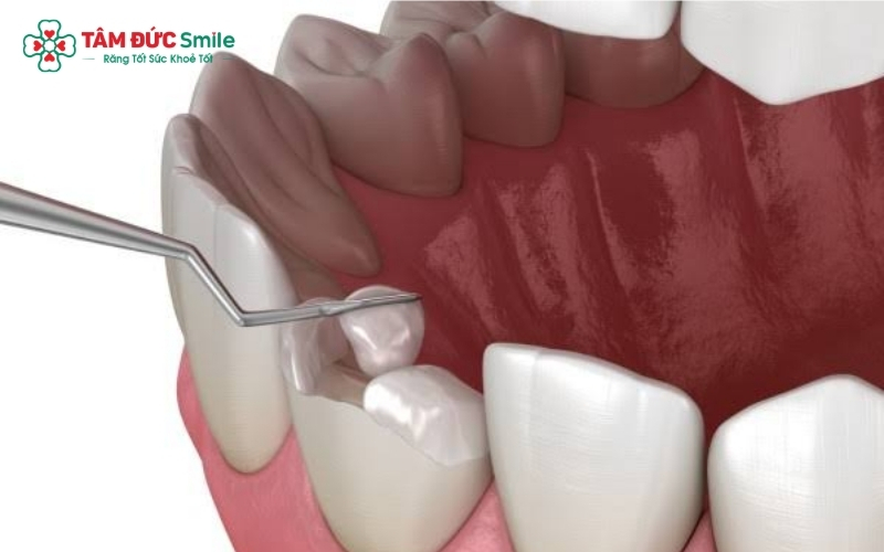 Răng bị mẻ nhẹ hoàn toàn có thể phục hồi vẻ ngoài thẩm mỹ và chức năng ăn nhai bằng phương pháp trám Composite.